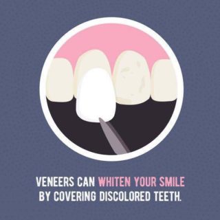 Veneers can whiten your smile