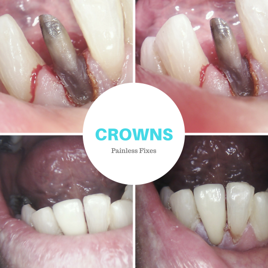painless fixes with crowns